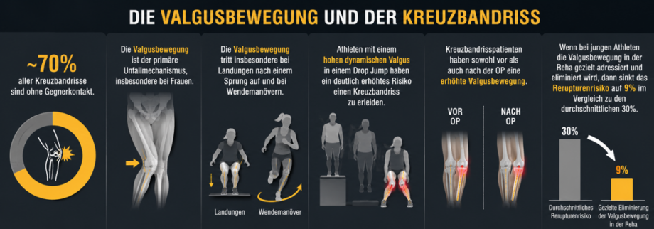 Zusammenhang von Valgusbewegung und Kreuzbandriss